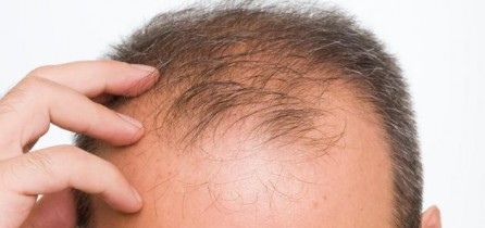 Staminali Niente piu calvizie ma dovrete aspettare un po