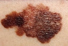 Staminali contro il melanoma avanzato!