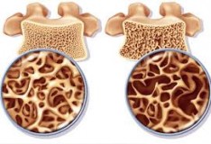 Bambini con Osteogenesi Imperfetta trattati in grembo con le staminali.