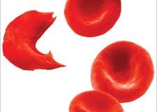 Staminali: La soluzione per l’anemia falciforme!