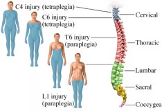 Staminali: Fase clinica per il trattamento di lesioni spinali.