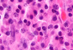 Staminali: Migliorano la vita di chi soffre di mieloma multiplo ma non fanno miracoli.