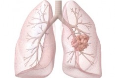 Staminali: Nuovo studio riguardo al mesotelioma.