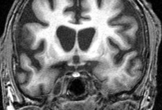 Le staminali contro le malattie del cervello.