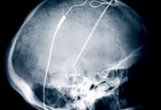 Staminali: Risposte sul Parkinson!