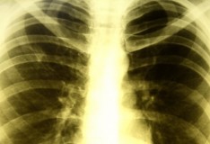 Staminali contro la tubercolosi!