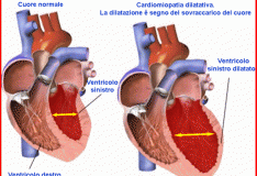 Staminali per curare la cardiomiopatia dilatativa ischemica!