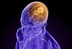 Create staminali che sconfiggono il tumore al cervello