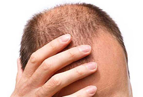 Staminali, un nuovo aiuto contro la perdita dei capelli