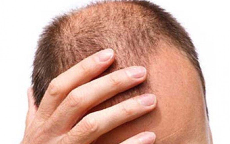 Le cellule staminali fanno crescere i capelli